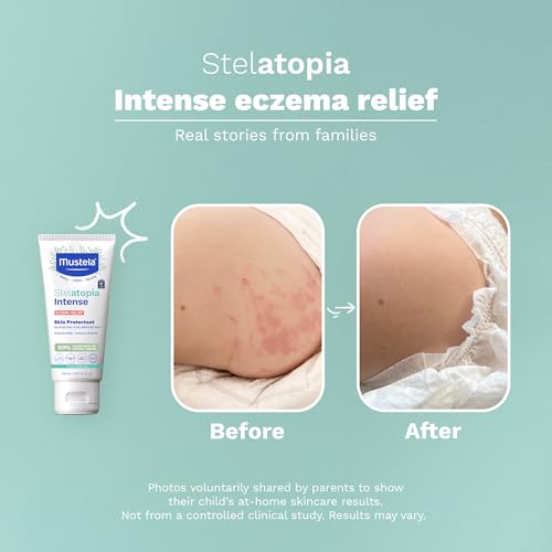 Mustela Eczema Relief Cream Stelatopia Intense - Fragrance-Free Moisturizing Body Lotion with Colloidal Oatmeal - For dry, itchy, irritated skin & flare-ups - Baby, Child & Adult - 5.07 fl. oz.
